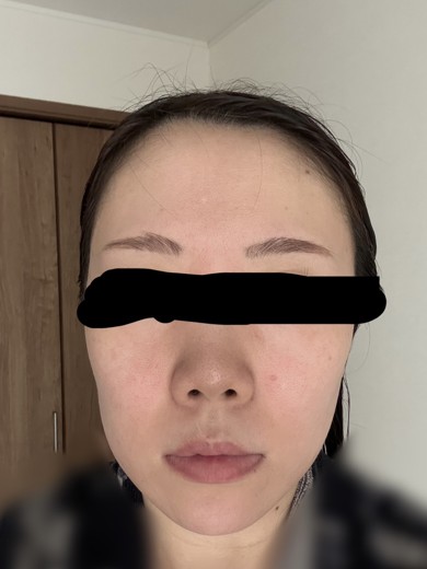 after photo: 水光注射