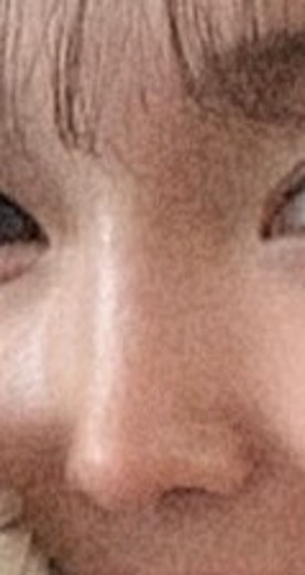 before photo: 코재수술