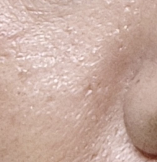 after photo: ダーマペン, PRP皮膚再生療法