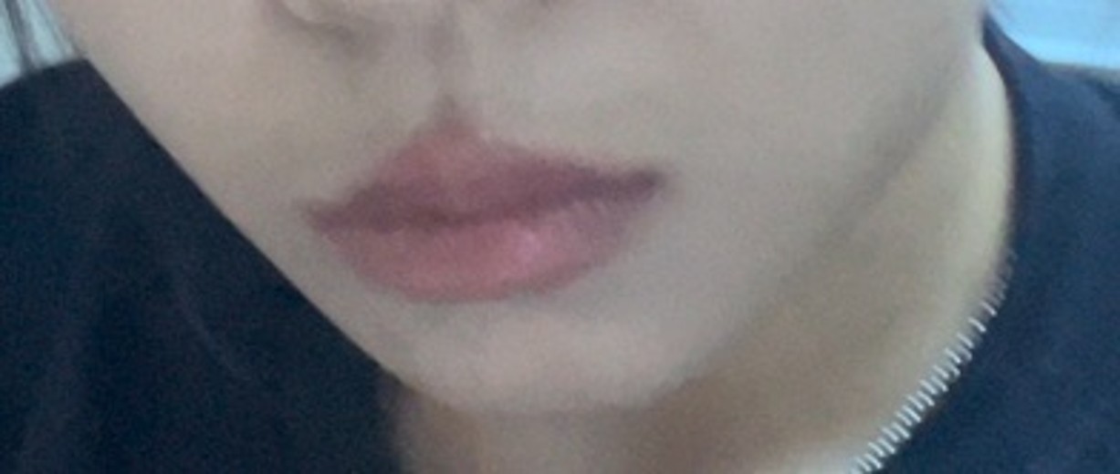 before photo: 턱필러