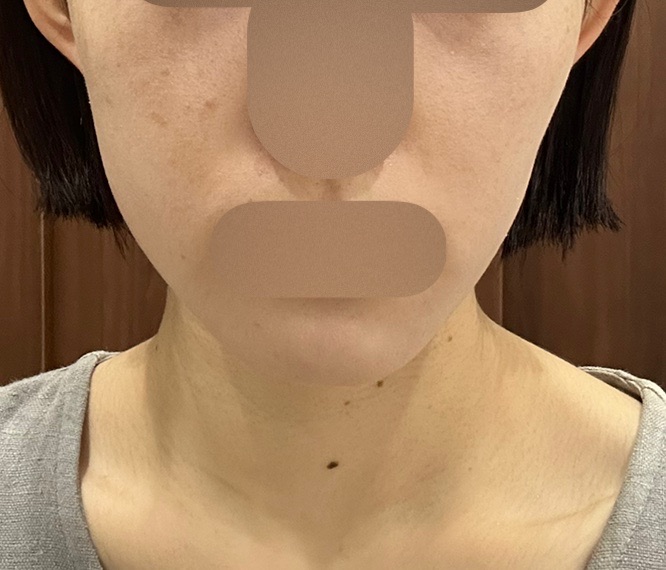 再来OK】エラ ボツリヌストキシン注射 | シティタワー新宿クリニック