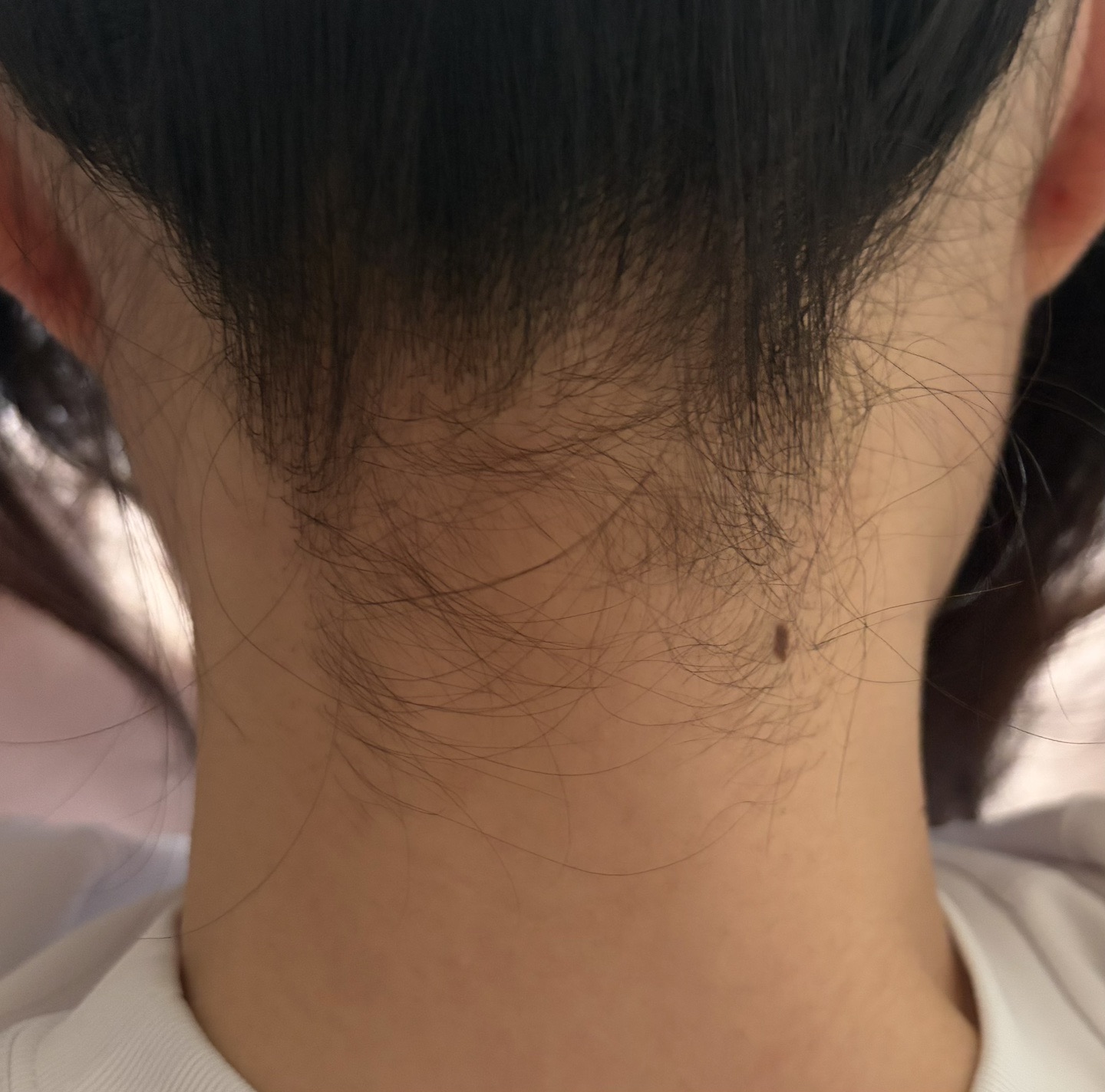 何度でも可】【女性限定】うなじ脱毛｜ジェントルマックスプロ
