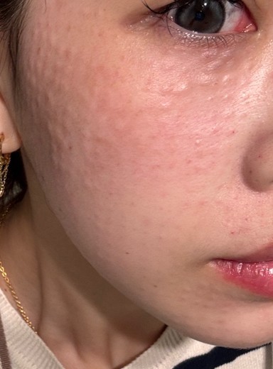 after photo: 水光注射, リズネ(LIZNE)