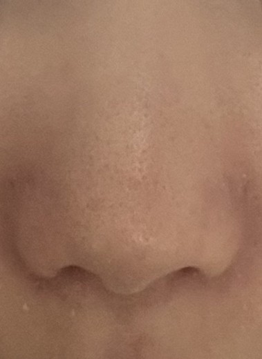 after photo: 콧볼축소