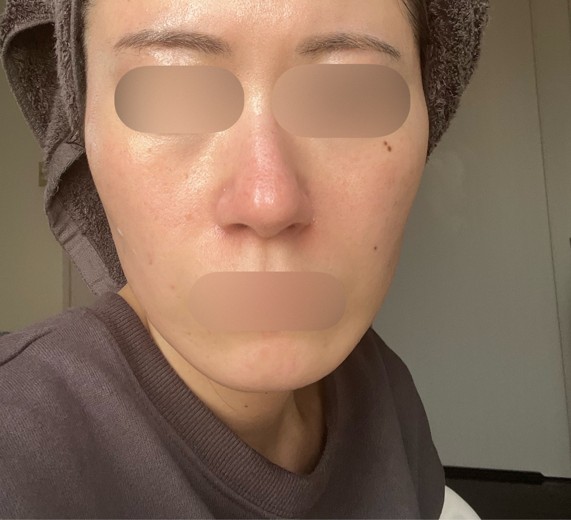 after photo: 水光注射, ジュベルック(Juvelook)