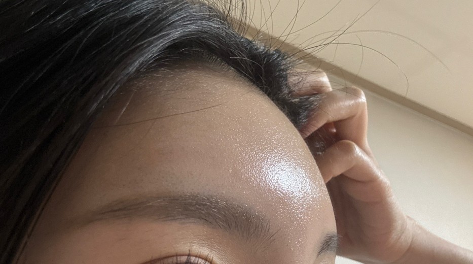 after photo: 이마필러