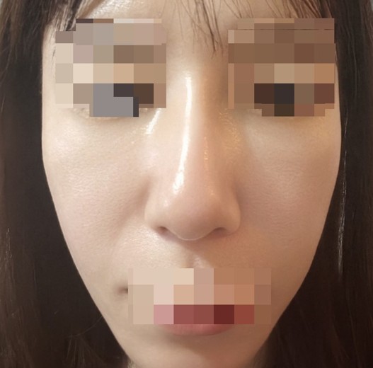 after photo: IPL(光/フォト治療), ピーリング, エレクトロポレーション