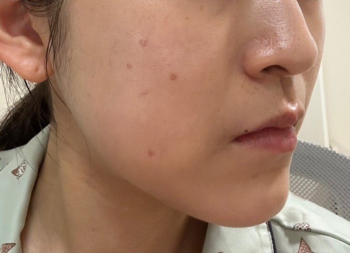 before photo: ピコスポット