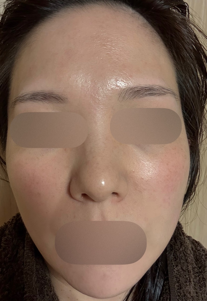 エレクトロポレーション＋ピーリング | フォンタナクリニック天神