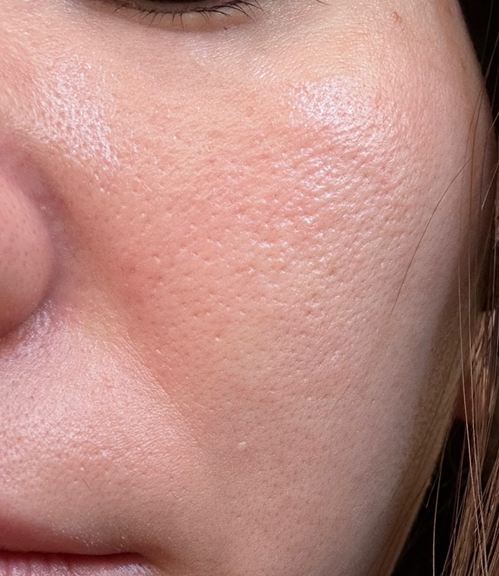 アクアピール＋エレクトロポレーション【薬剤代込】【再来OK