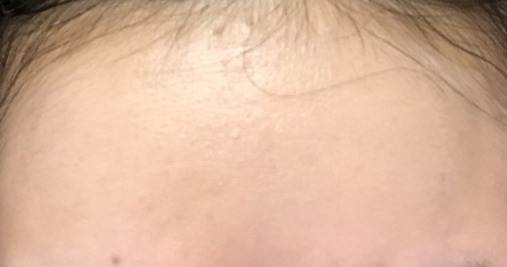 after photo: ハイドラジェントル