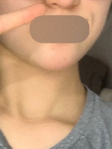 after photo: 필러제거주사