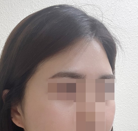 before photo: 이마필러