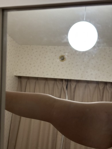 after photo: 脂肪冷却(背中)