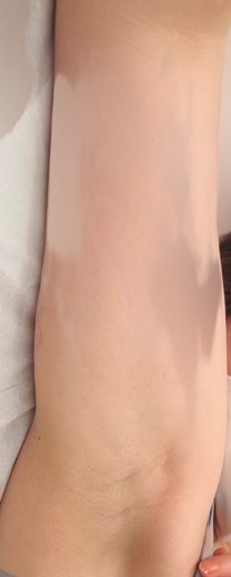 before photo: 脇ボトックス, 多汗症ボトックス
