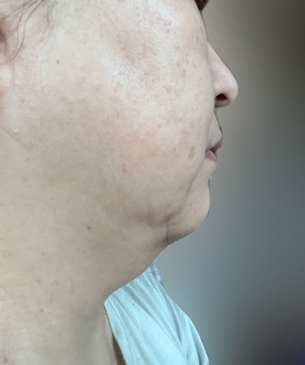 before photo: 脂肪溶解注射(顔)