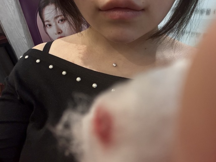 after photo: 턱끝보톡스, 턱끝필러