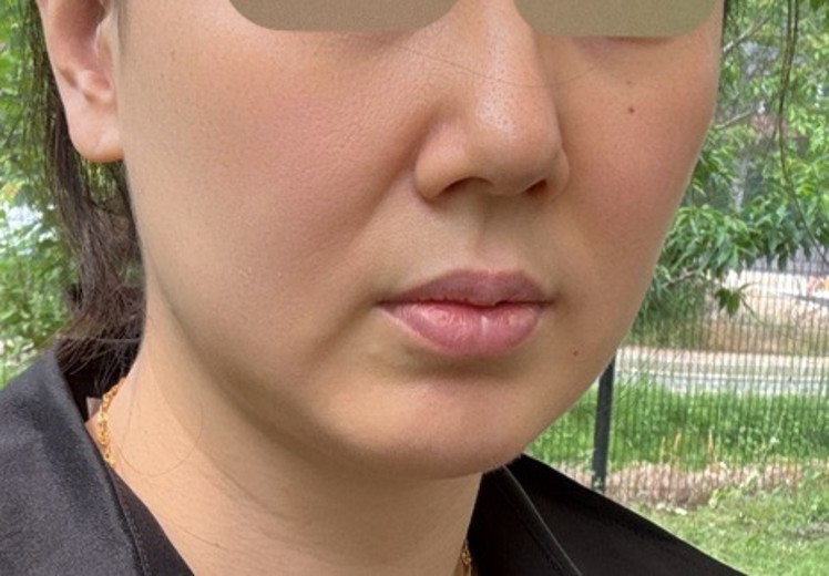 before photo: 스킨보톡스