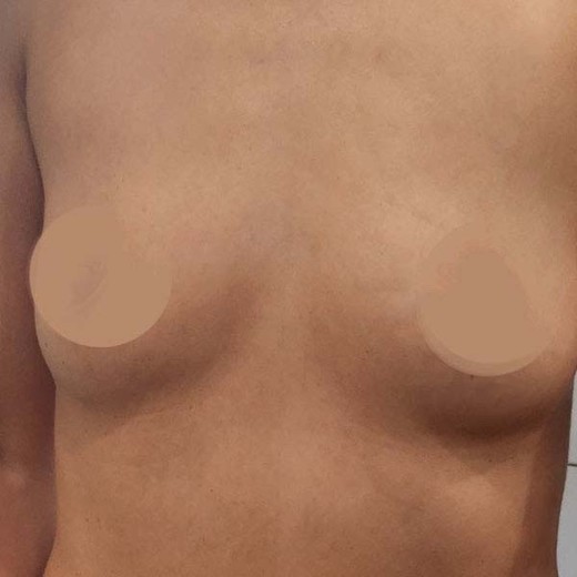 before photo: 가슴(보형물)