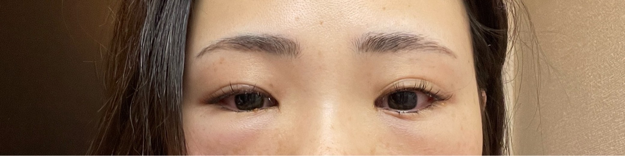 after photo: 脱脂(クマ治療)