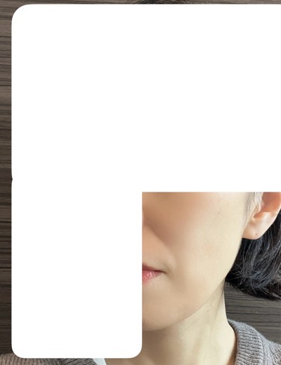 after photo: ウルトラフォーマー3(ハイフ)