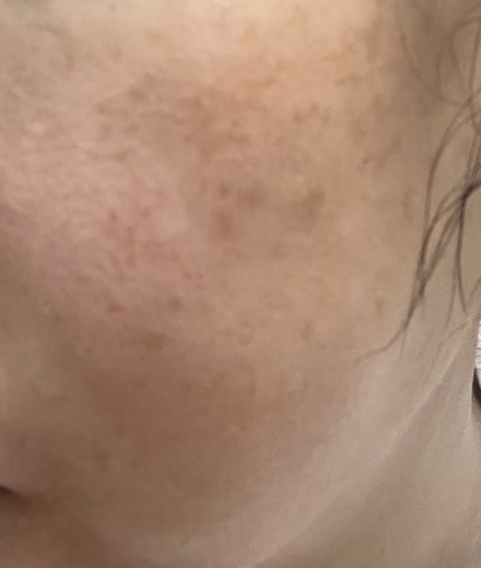 before photo: 스킨보톡스