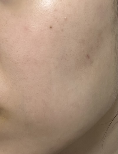 after photo: IPL(光/フォト治療)