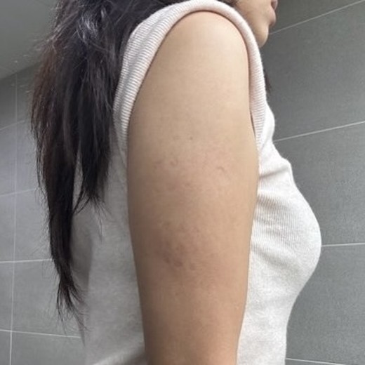 before photo: 脂肪溶解注射(腕)