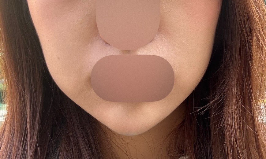 after photo: 턱끝필러