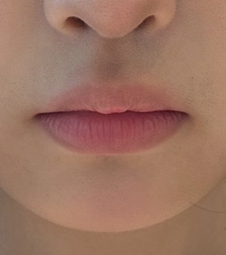 before photo: 입술필러