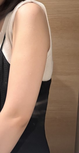 after photo: 脂肪冷却(腕)