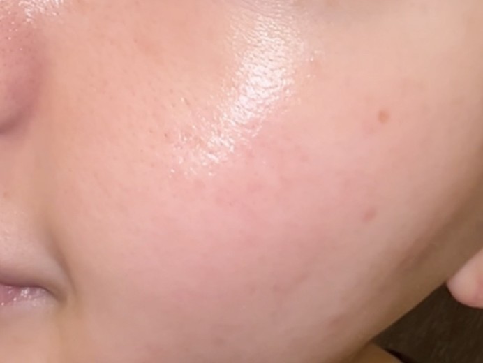 after photo: IPL(光/フォト治療), エレクトロポレーション, ルメッカ
