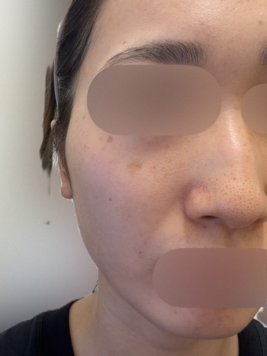 before photo: ハイドラフェイシャル, 診断・検査