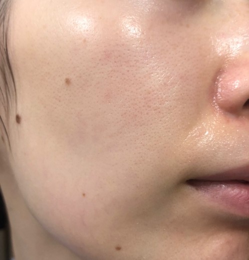 after photo: エレクトロポレーション