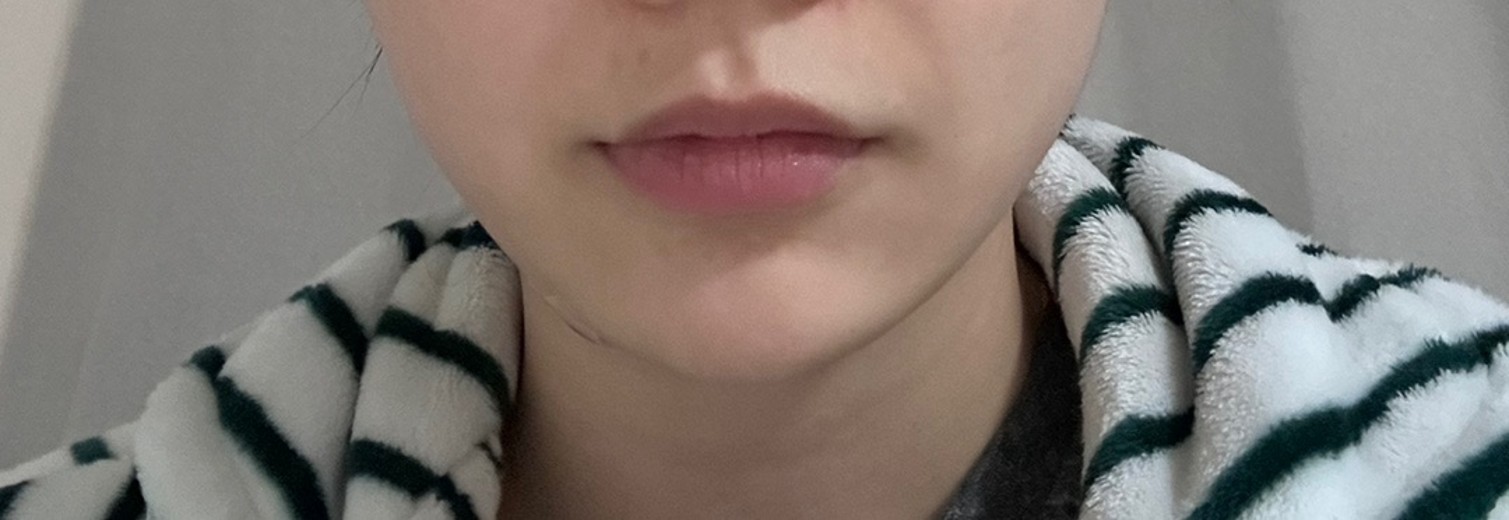 after photo: 턱끝필러