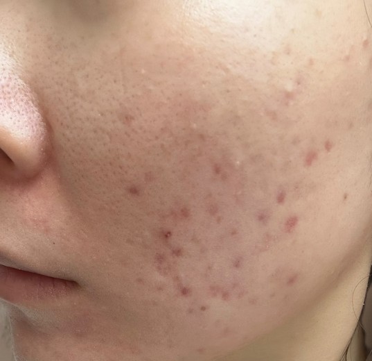 before photo: IPL(光/フォト治療), 診断・検査