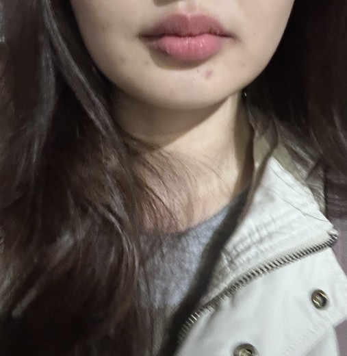 before photo: 턱끝보톡스, 턱끝필러