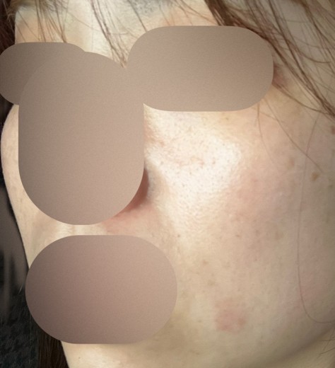 before photo: レーザートーニング, 診断・検査