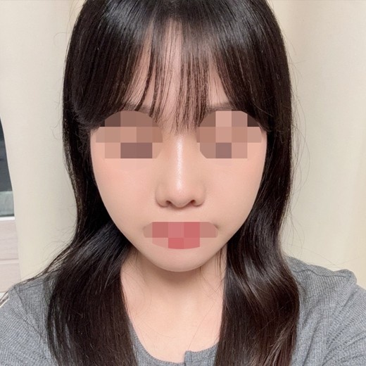 after photo: 콧볼축소