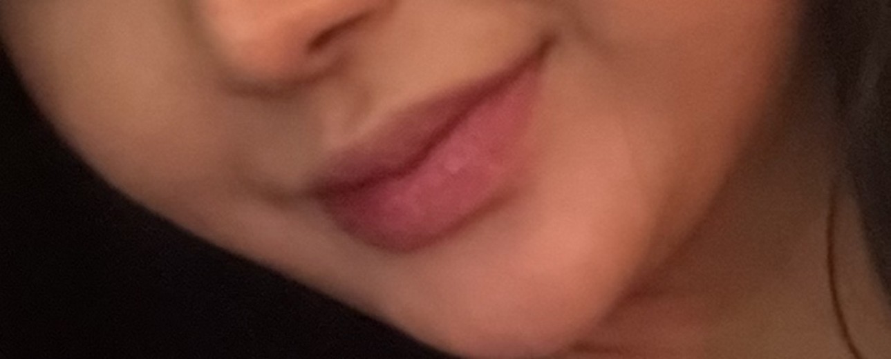 before photo: 보조개성형