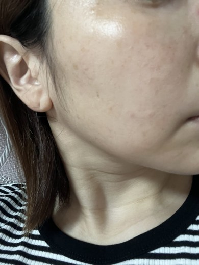before photo: ダーマペン