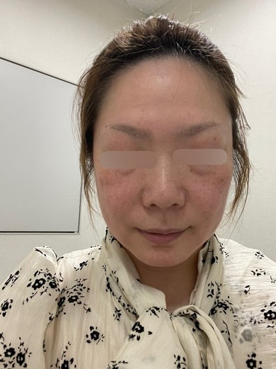 before photo: ダーマペン