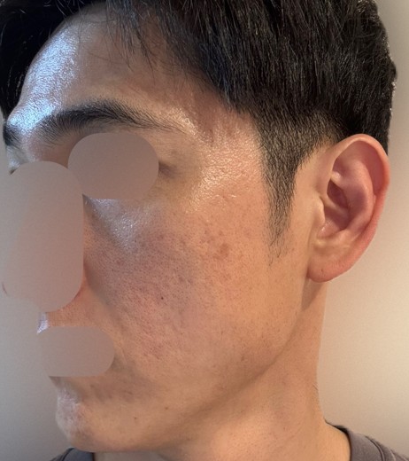 after photo: ピコフラクショナル
