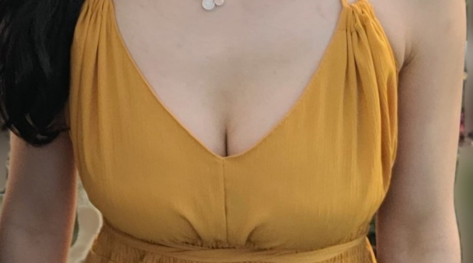 after photo: 가슴(보형물)