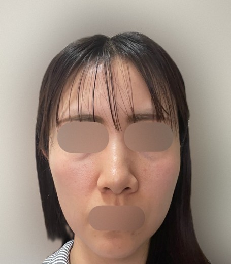 after photo: ルメッカ