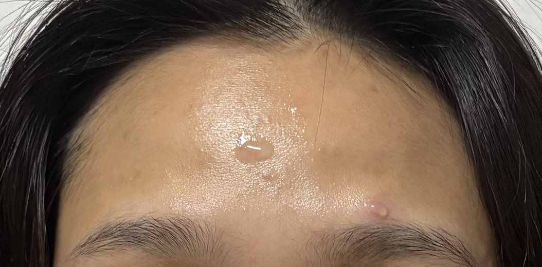 before photo: 이마필러, 관자놀이필러