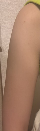 before photo: 脂肪冷却(腕)