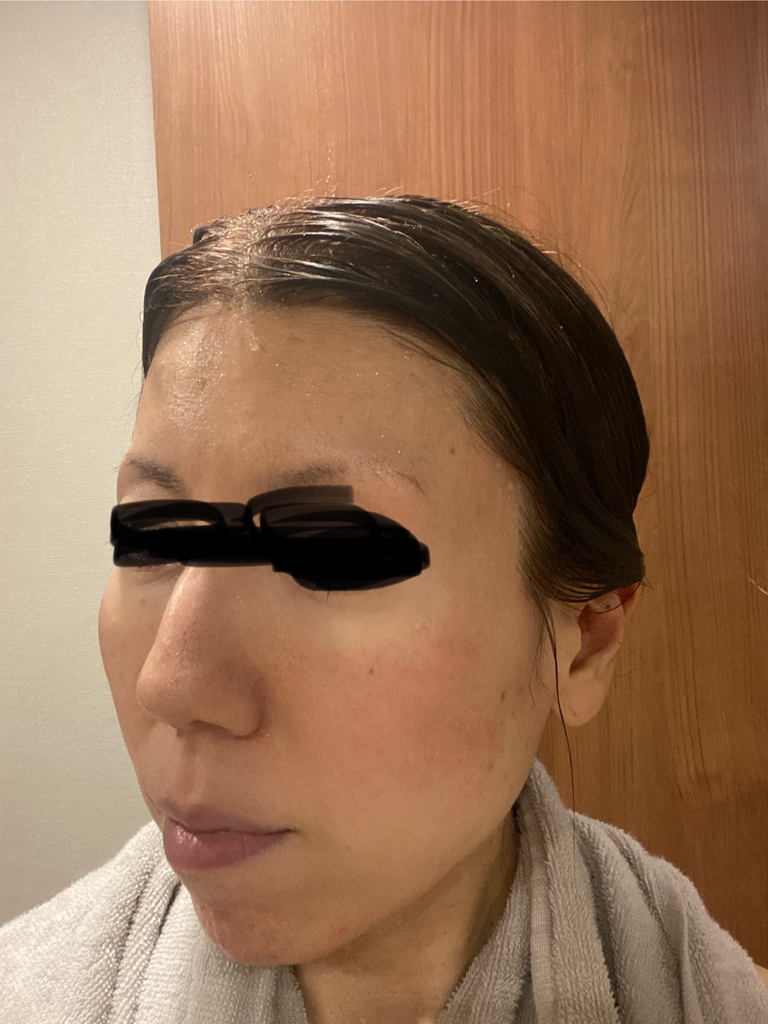 10月31日迄のご予約で初診料0円】IPL（光治療）全顔2周