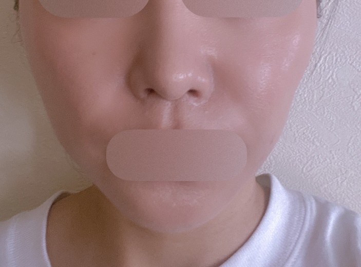 after photo: ピーリング, エレクトロポレーション, マッサージピール(コラーゲンピール)