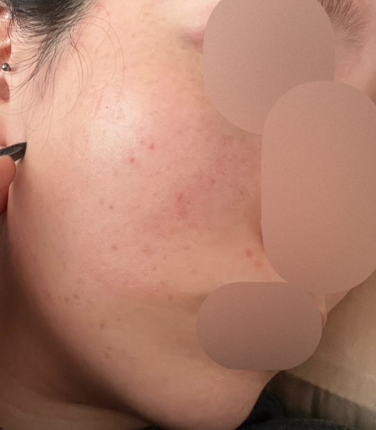 再来OK】ハイドラフェイシャル＋エレクトロポレーション | おおかみ